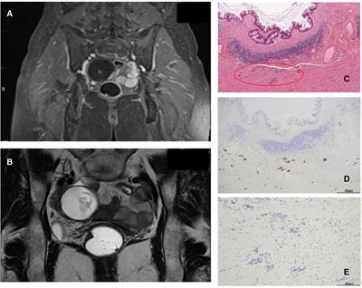 Appendiceal collision tumors: case reports, management and literature review